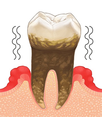 虫歯や歯周病のリスクが高まる