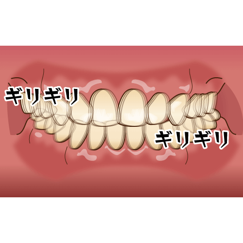 歯ぎしり・食いしばりなどを引き起こす