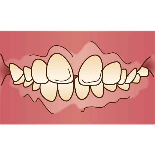 出っ歯の治療はマウスピース矯正で可能な場合がございます。