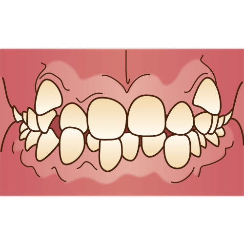 叢生の治療はマウスピース矯正で可能な場合がございます。
