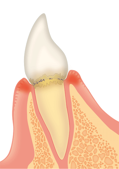 歯周病の初期段階