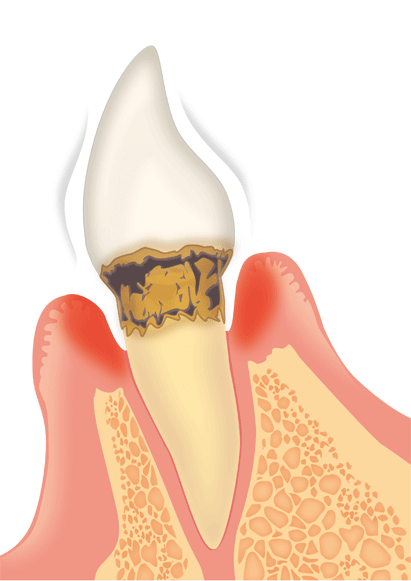 歯周病の中等度