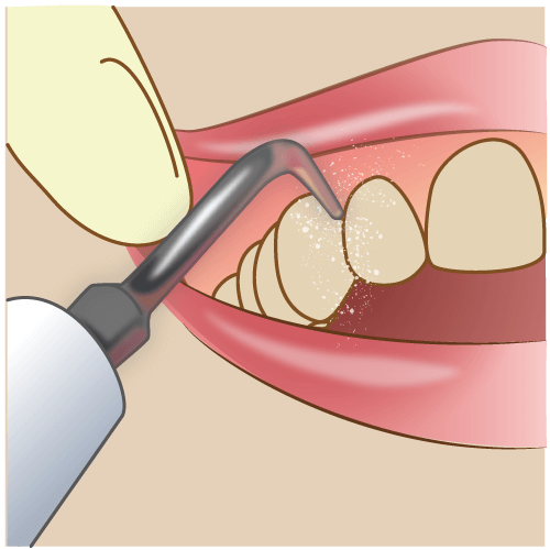 歯石とり・歯石除去|桂駅の岩崎歯科医院
