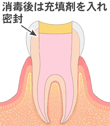 根管内に薬剤を充填します